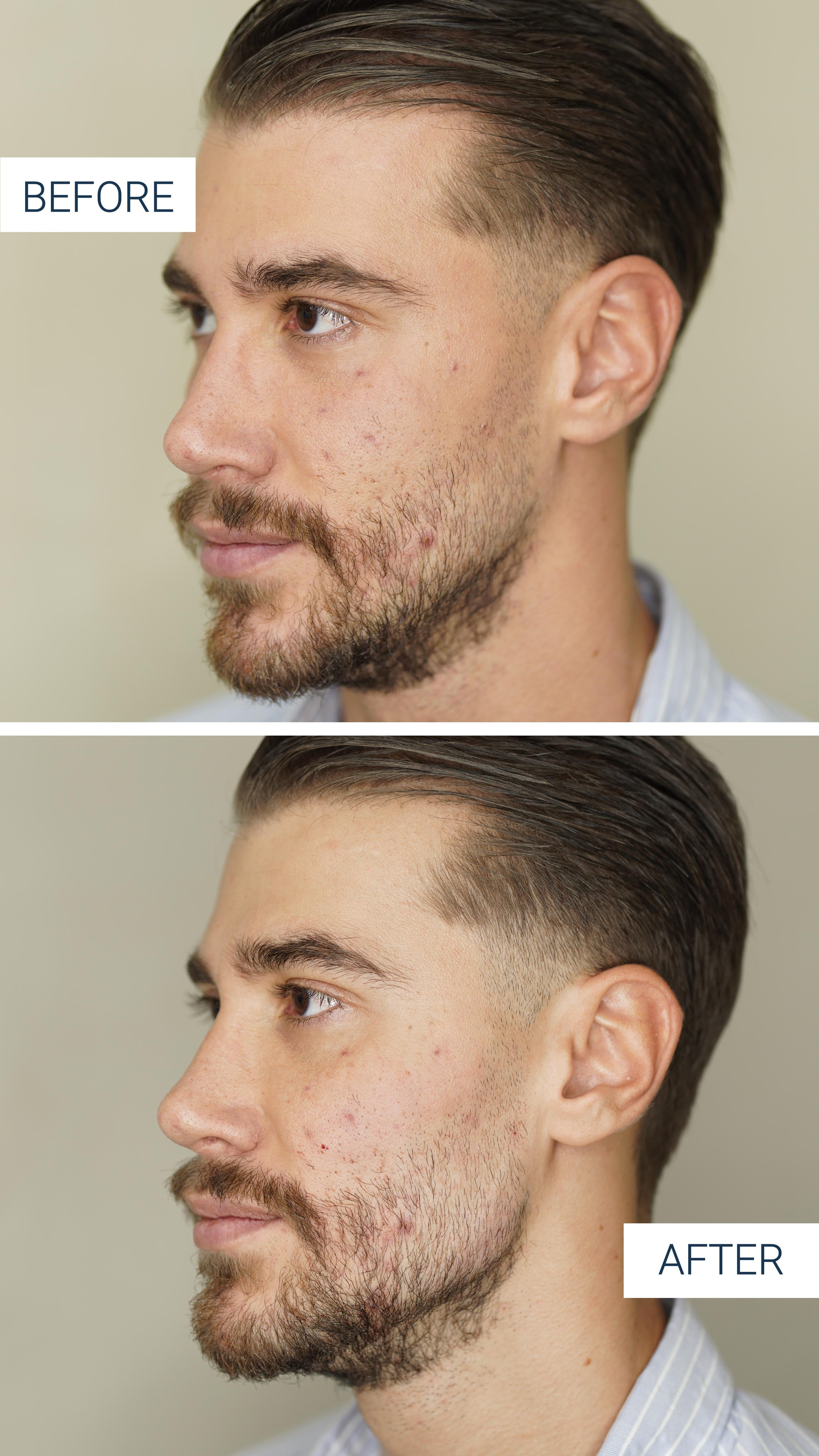 faceContouringJawlineCheek before